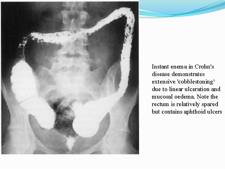 Instant enema in Crohn's disease demonstrates extensive 'cobblestoning' due to linear ulceration and mucosal