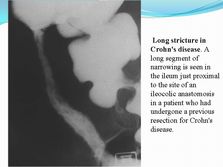 Long stricture in Crohn's disease. A long segment of narrowing is seen in the