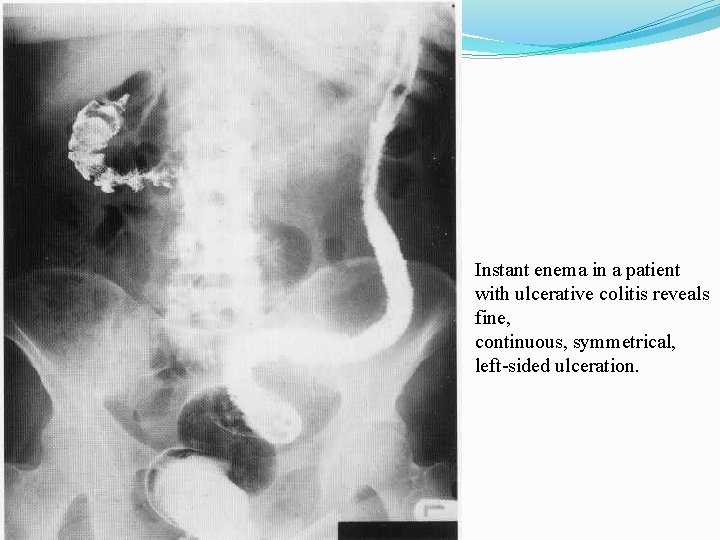 Instant enema in a patient with ulcerative colitis reveals fine, continuous, symmetrical, left-sided ulceration.