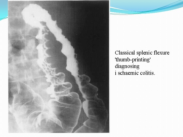 Classical splenic flexure 'thumb-printing' diagnosing i schaemic colitis. 