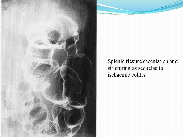 Splenic flexure sacculation and stricturing as sequelae to ischaemic colitis. 