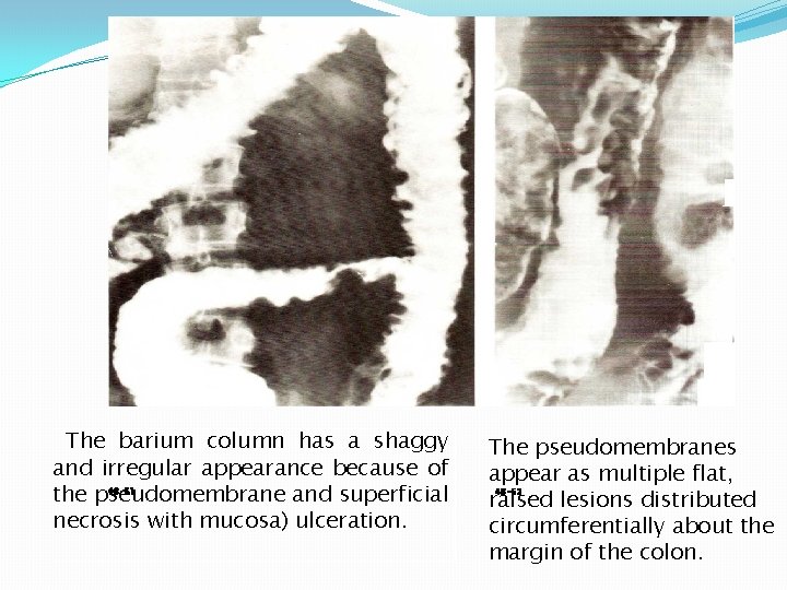 The barium column has a shaggy and irregular appearance because of the pseudomembrane and
