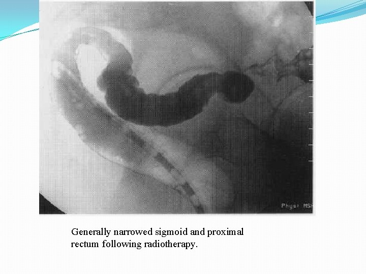 Generally narrowed sigmoid and proximal rectum following radiotherapy. 