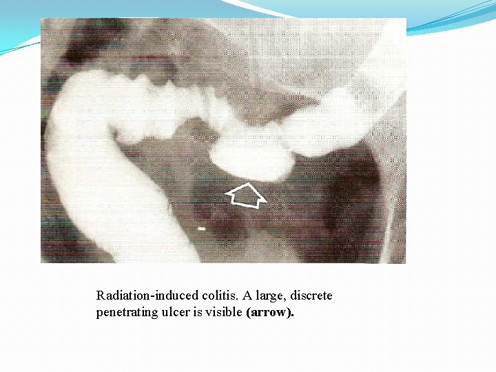 Radiation-induced colitis. A large, discrete penetrating ulcer is visible (arrow). 