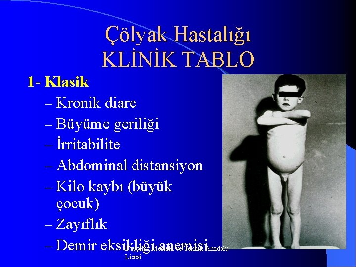 Çölyak Hastalığı KLİNİK TABLO 1 Klasik – Kronik diare – Büyüme geriliği – İrritabilite