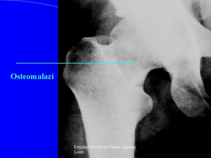 Osteomalazi Beyşehir Mesleki ve Teknik Anadolu Lisesi 