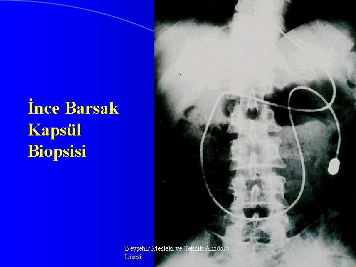 İnce Barsak Kapsül Biopsisi Beyşehir Mesleki ve Teknik Anadolu Lisesi 