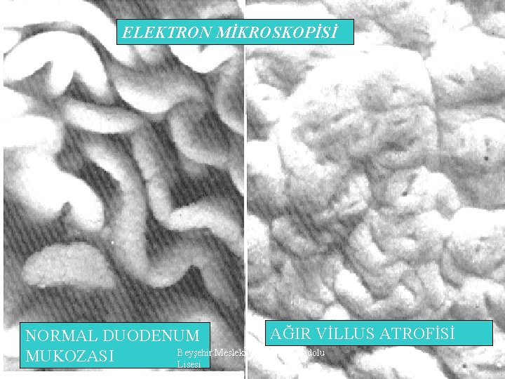 ELEKTRON MİKROSKOPİSİ AĞIR VİLLUS ATROFİSİ NORMAL DUODENUM Beyşehir Mesleki ve Teknik Anadolu MUKOZASI Lisesi