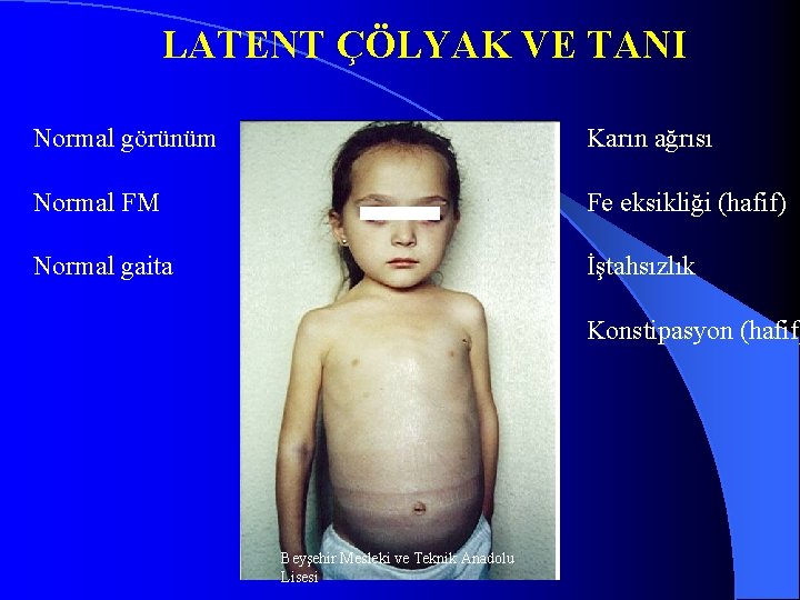 LATENT ÇÖLYAK VE TANI Normal görünüm Karın ağrısı Normal FM Fe eksikliği (hafif) Normal