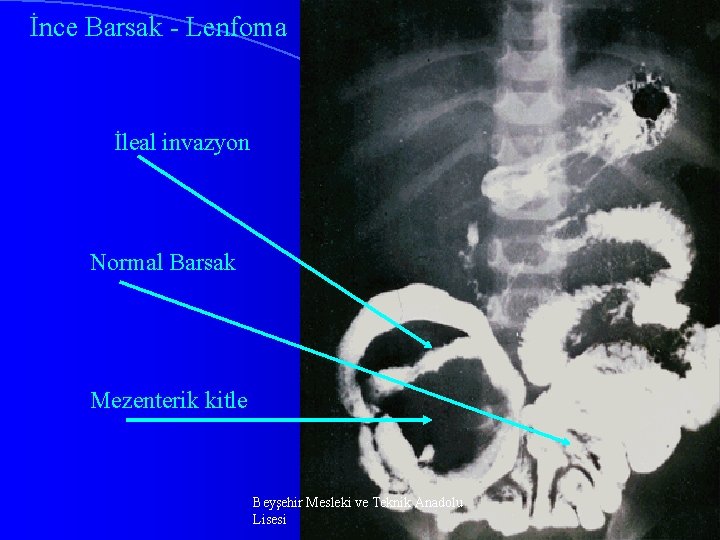 İnce Barsak - Lenfoma İleal invazyon Normal Barsak Mezenterik kitle Beyşehir Mesleki ve Teknik