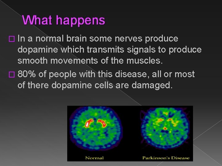 What happens � In a normal brain some nerves produce dopamine which transmits signals