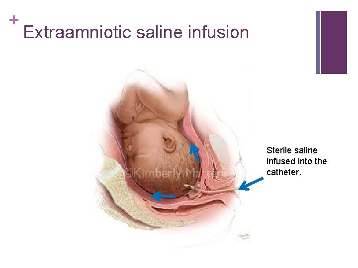 + Extraamniotic saline infusion Sterile saline infused into the catheter. 
