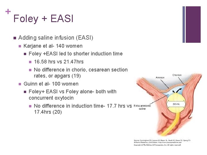 + Foley + EASI n Adding saline infusion (EASI) n Karjane et al- 140