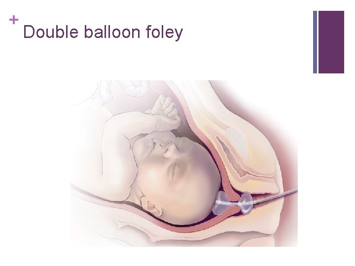 + Double balloon foley 