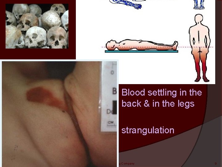 Blood settling in the back & in the legs strangulation Kendall/Hunt Publishing Company 9