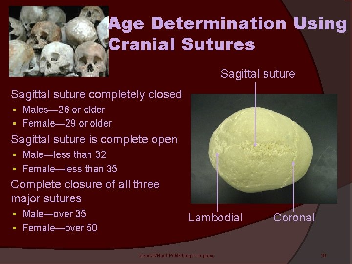 Age Determination Using Cranial Sutures Sagittal suture completely closed § Males— 26 or older