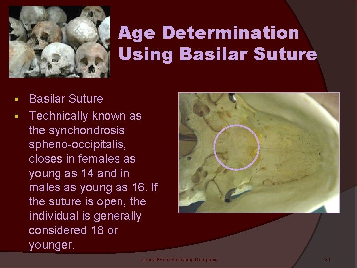 Age Determination Using Basilar Suture § Technically known as the synchondrosis spheno-occipitalis, closes in