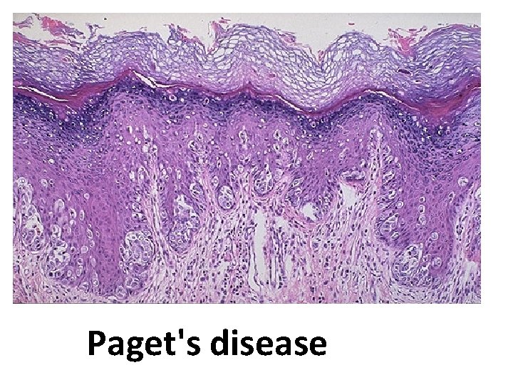 Paget's disease 