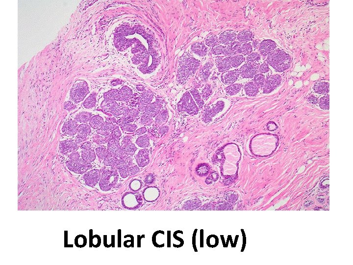 Lobular CIS (low) 