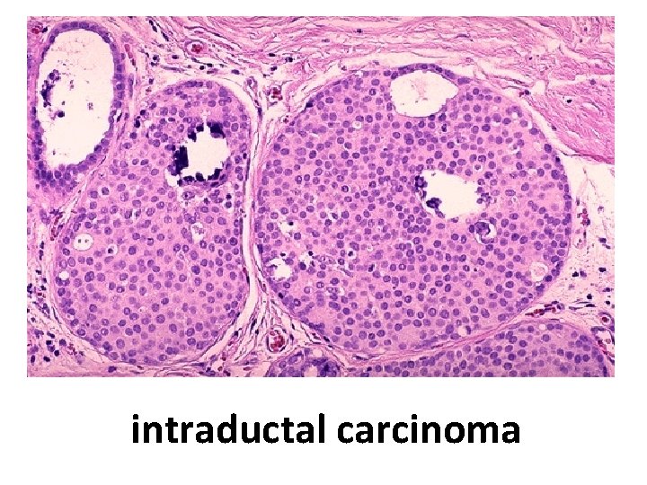 intraductal carcinoma 