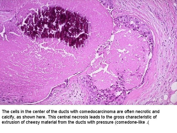 The cells in the center of the ducts with comedocarcinoma are often necrotic and