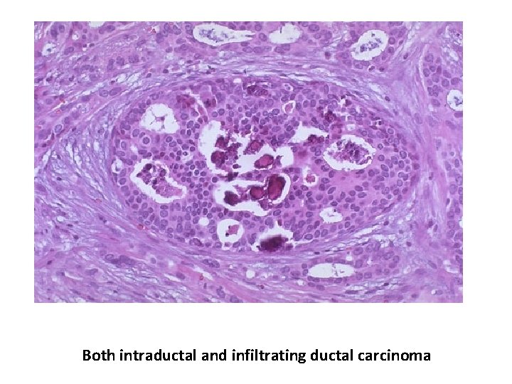 Both intraductal and infiltrating ductal carcinoma 