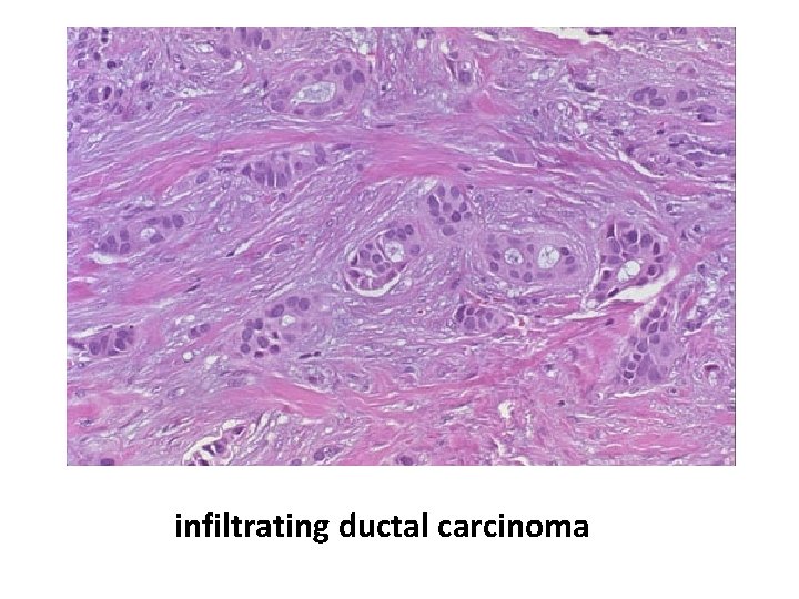 infiltrating ductal carcinoma 