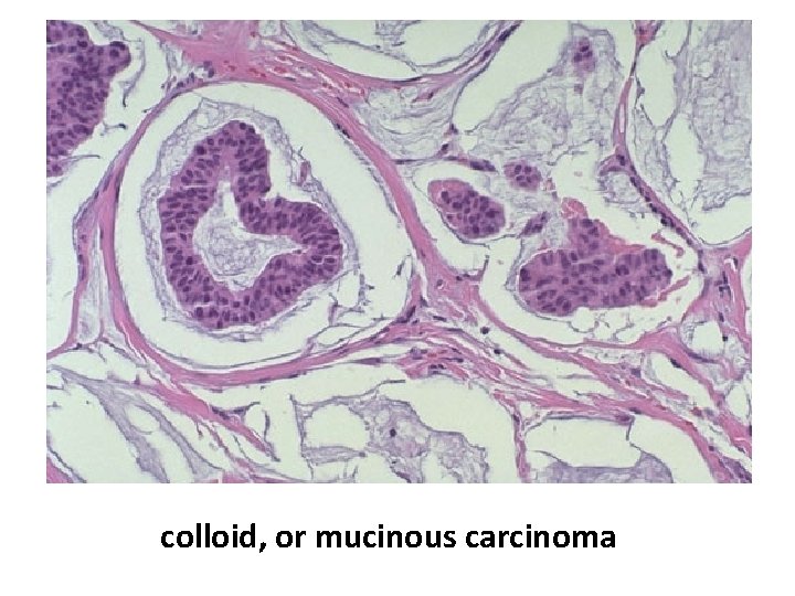 colloid, or mucinous carcinoma 