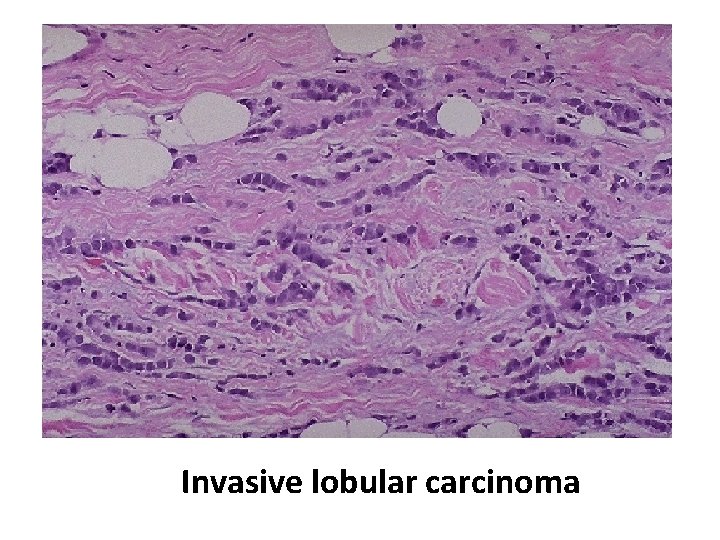 Invasive lobular carcinoma 