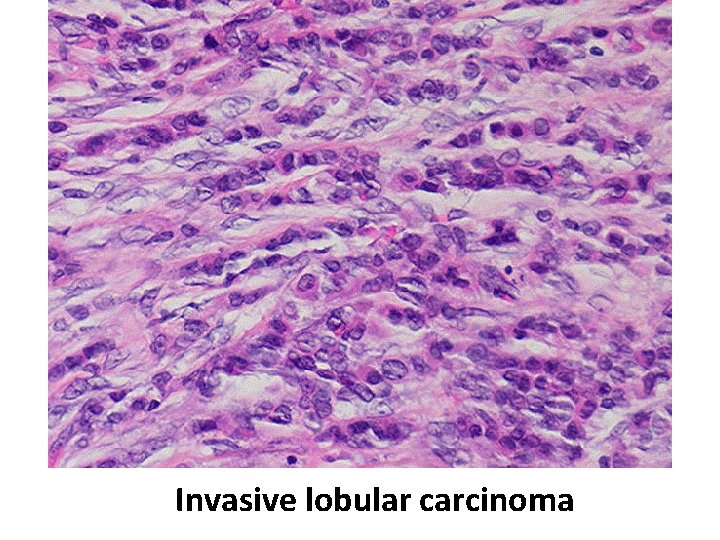 Invasive lobular carcinoma 