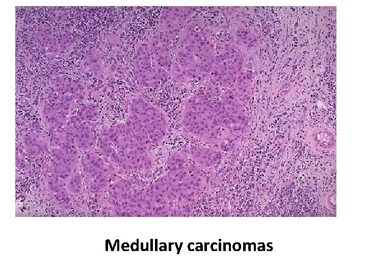 Medullary carcinomas 