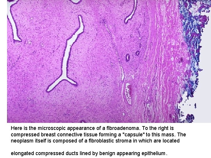 Here is the microscopic appearance of a fibroadenoma. To the right is compressed breast