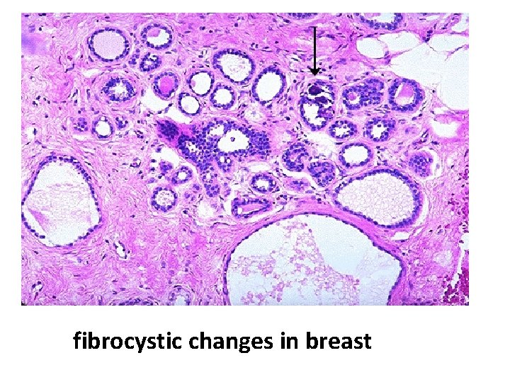 fibrocystic changes in breast 
