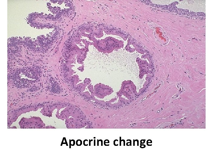 Apocrine change 