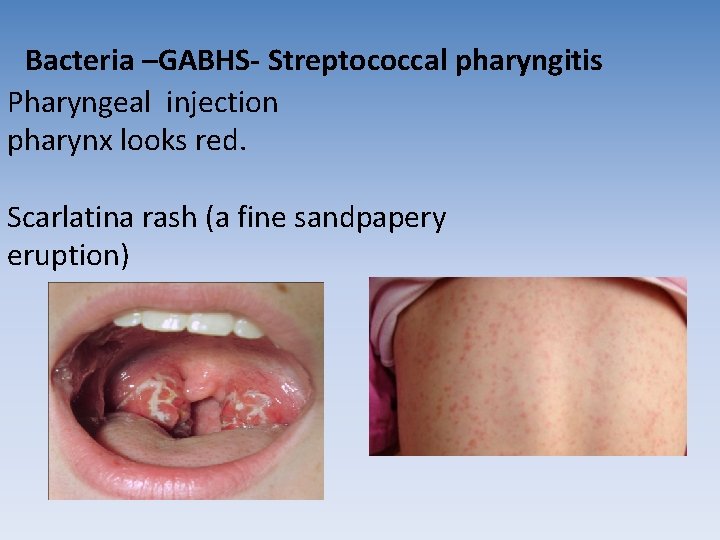 Bacteria –GABHS- Streptococcal pharyngitis Pharyngeal injection pharynx looks red. Scarlatina rash (a fine sandpapery Bacteria –GABHS- Streptococcal pharyngitis Pharyngeal injection pharynx looks red. Scarlatina rash (a fine sandpapery