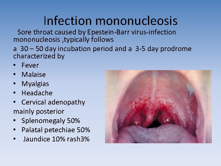 Infection mononucleosis Sore throat caused by Epestein-Barr virus-infection mononucleosis , typically follows a 30 Infection mononucleosis Sore throat caused by Epestein-Barr virus-infection mononucleosis , typically follows a 30