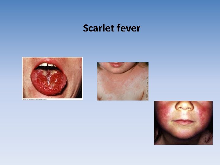 Scarlet fever Scarlet fever