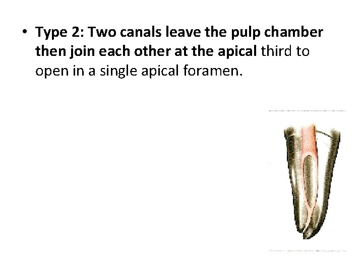  • Type 2: Two canals leave the pulp chamber then join each other