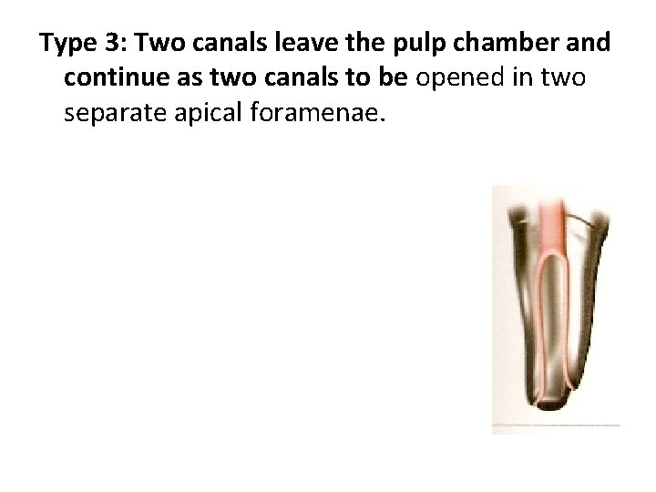 Type 3: Two canals leave the pulp chamber and continue as two canals to