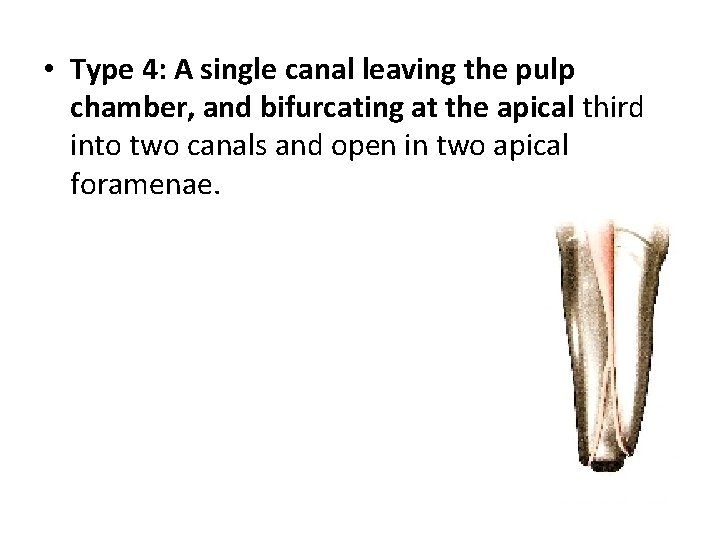  • Type 4: A single canal leaving the pulp chamber, and bifurcating at