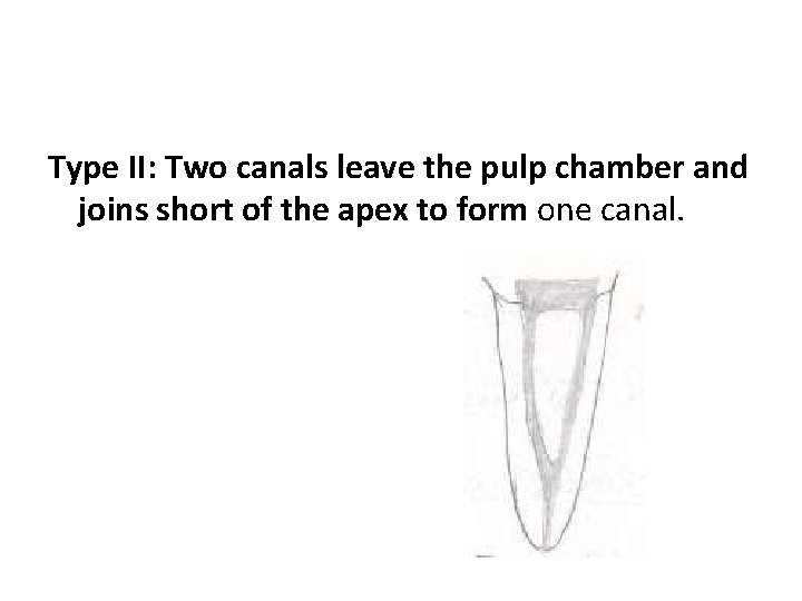 Type II: Two canals leave the pulp chamber and joins short of the apex