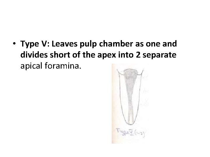  • Type V: Leaves pulp chamber as one and divides short of the