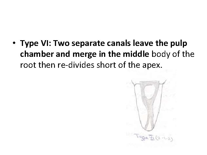  • Type VI: Two separate canals leave the pulp chamber and merge in