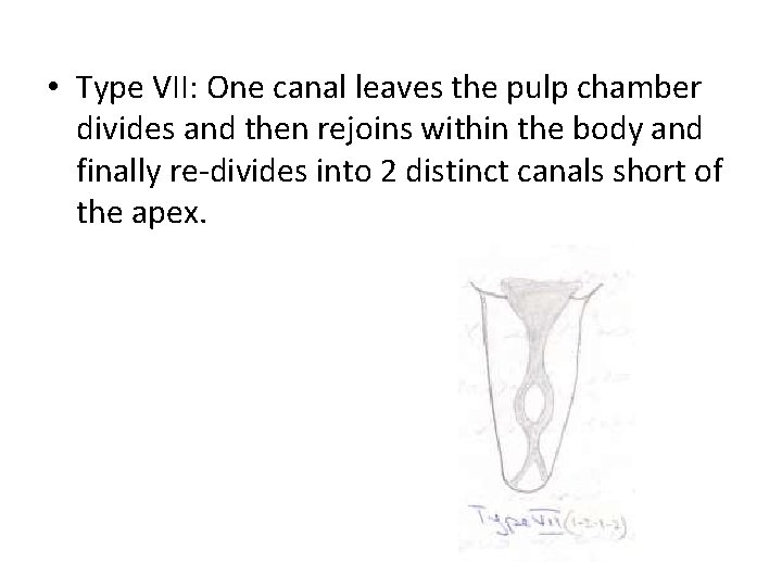  • Type VII: One canal leaves the pulp chamber divides and then rejoins