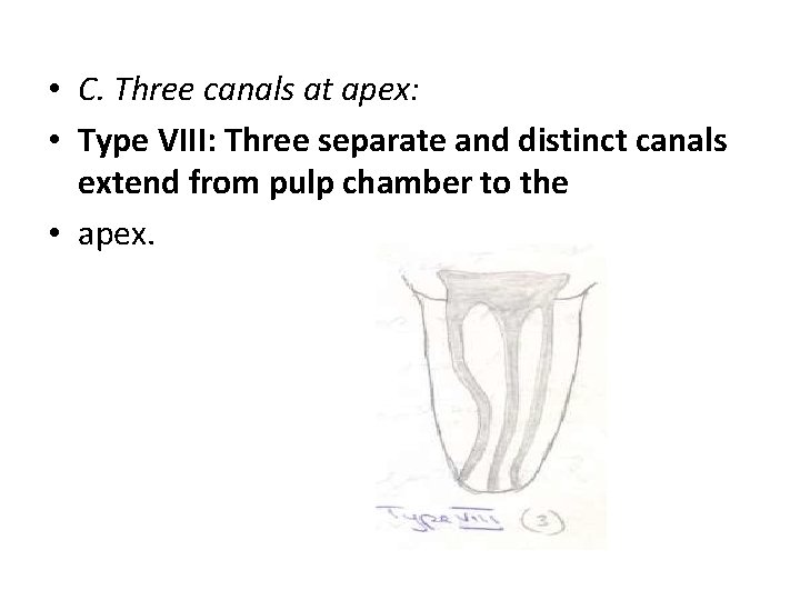  • C. Three canals at apex: • Type VIII: Three separate and distinct