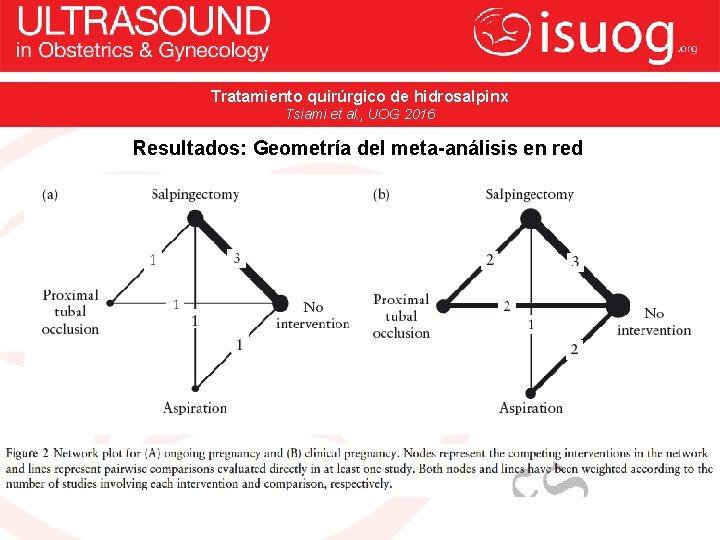 Tratamiento quirúrgico de hidrosalpinx Tsiami et al. , UOG 2016 Resultados: Geometría del meta-análisis