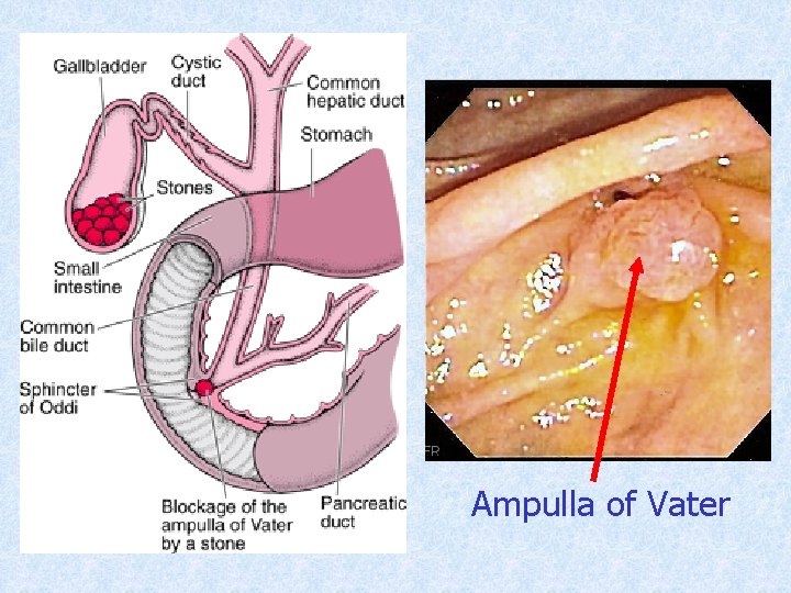 Ampulla of Vater 