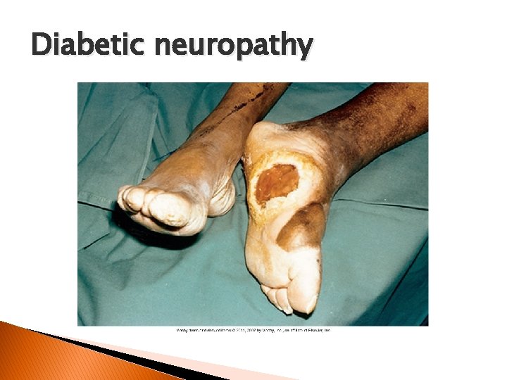 Diabetic neuropathy 