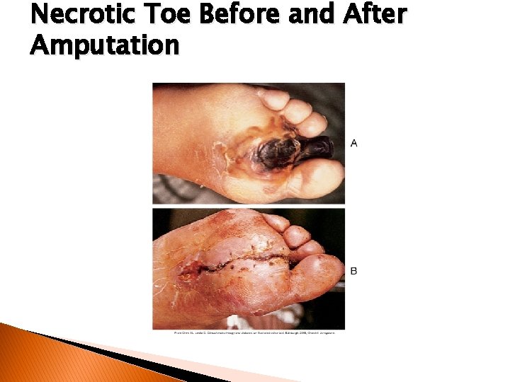 Necrotic Toe Before and After Amputation 