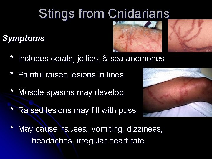 Stings from Cnidarians Symptoms * Includes corals, jellies, & sea anemones * Painful raised